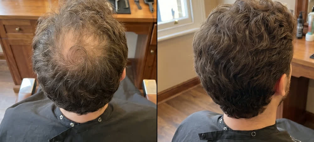 nuca con capelli ricci prima e dopo l'applicazione di Rootia castano medio