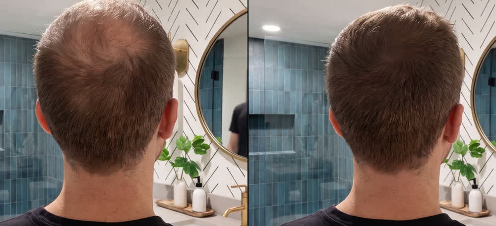 nuca con capelli corti prima e dopo l'applicazione di Rootia castano medio